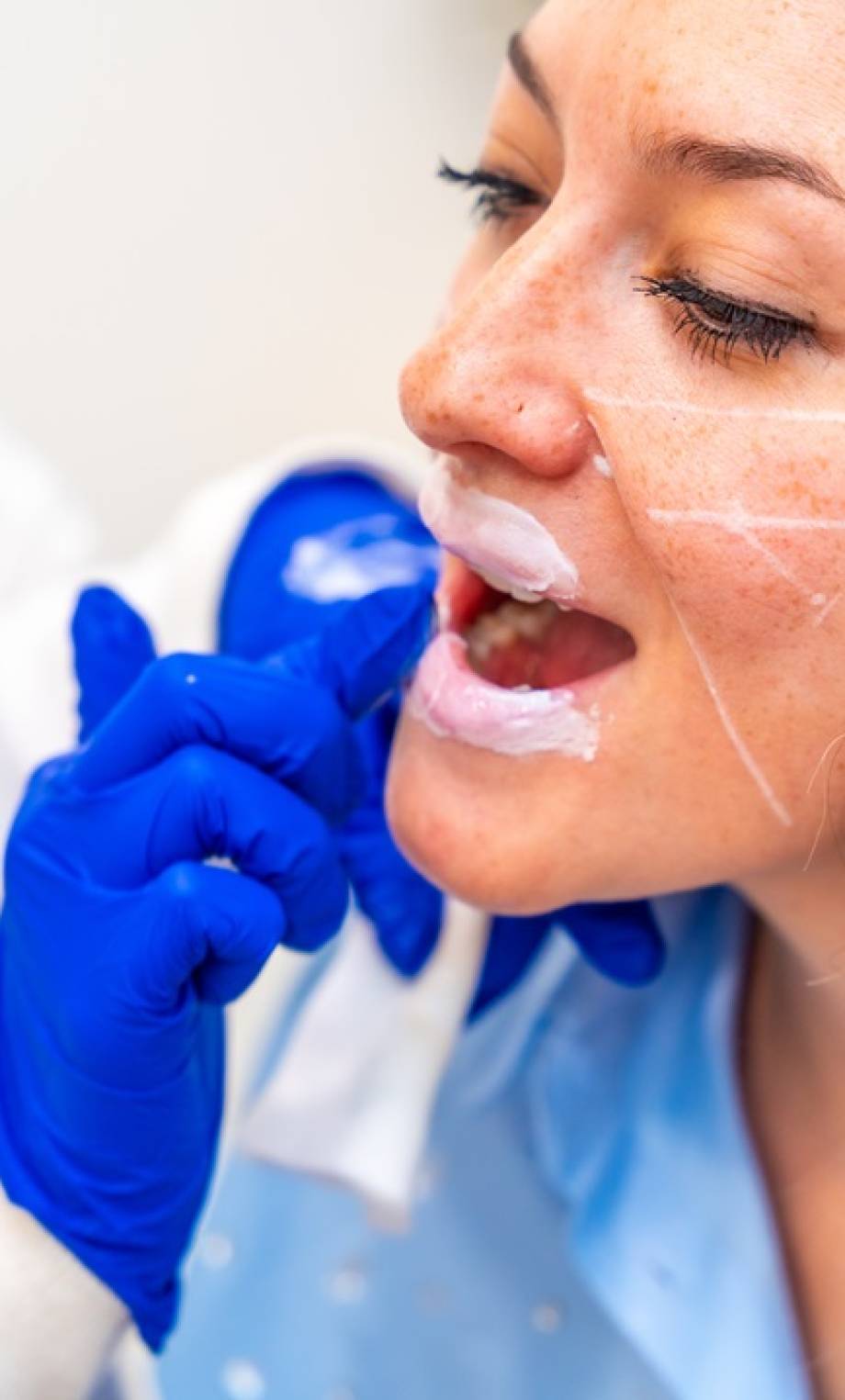 Aesthetic female doctor applying numbing cream on the lips of a patient before injecting hyaluronic acid